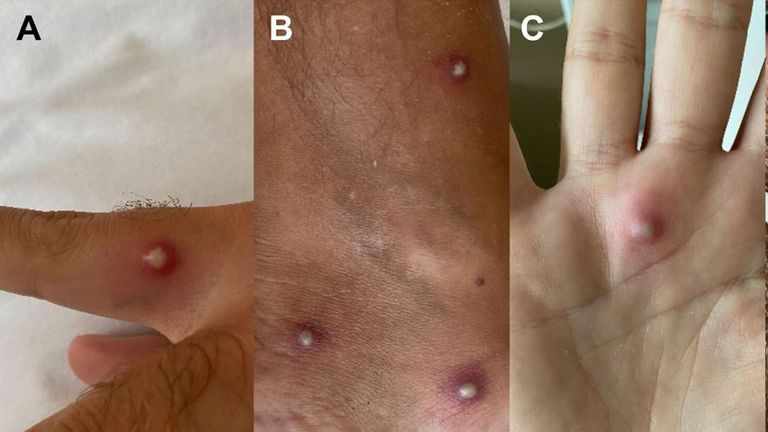 Man tests positive for monkeypox, COVID and HIV after holiday to Spain